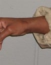 Photograph taken in 2002 - Scar on wrist